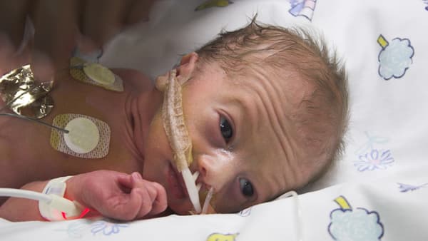 Parto prematuro: cuando el bebé nace demasiado pronto